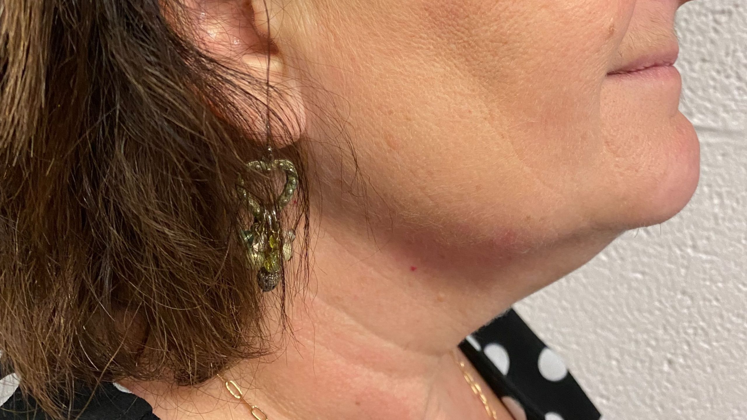 Kybella2 scaled | Well House - Wellness and Aesthetic Services