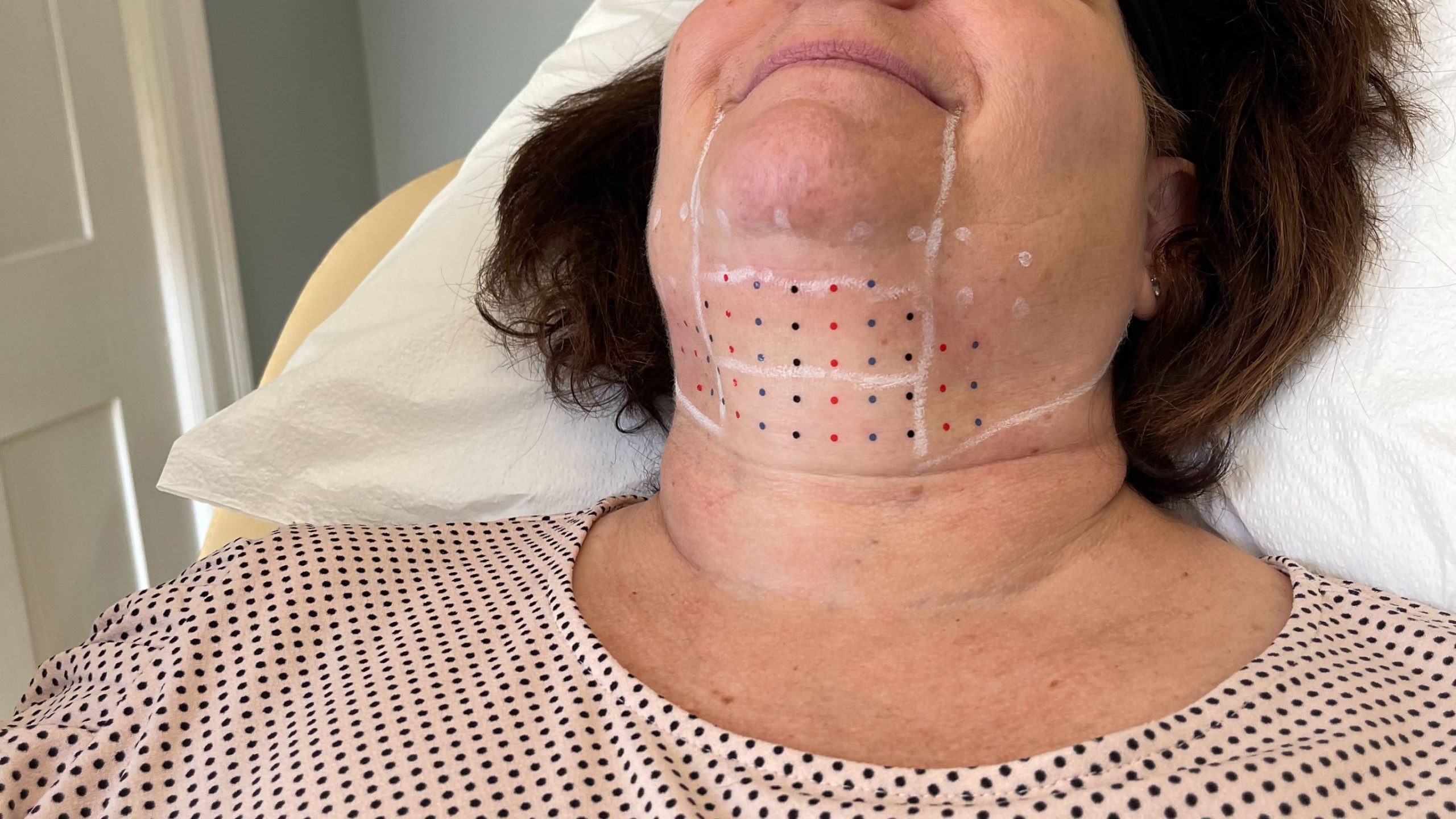 Kybella4 scaled | Well House - Wellness and Aesthetic Services