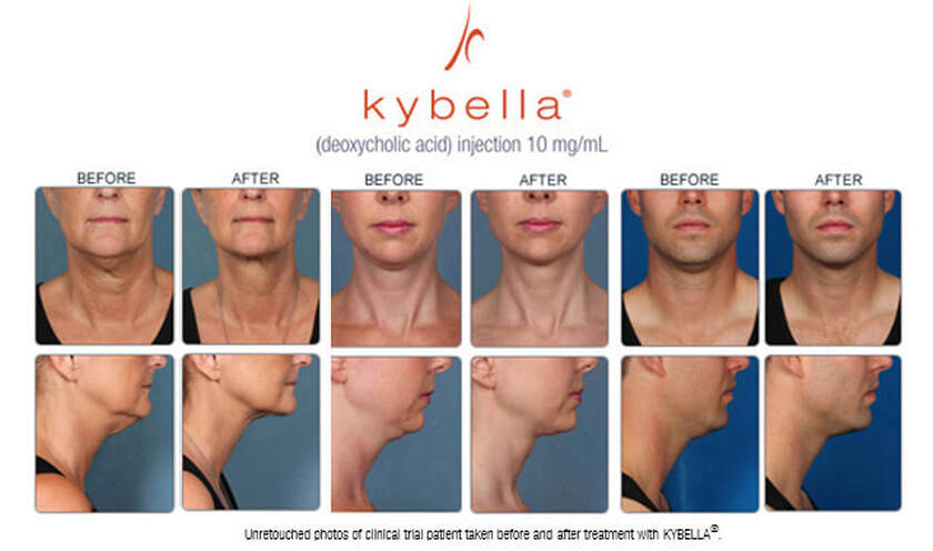 kybella before afterb | Well House - Wellness and Aesthetic Services